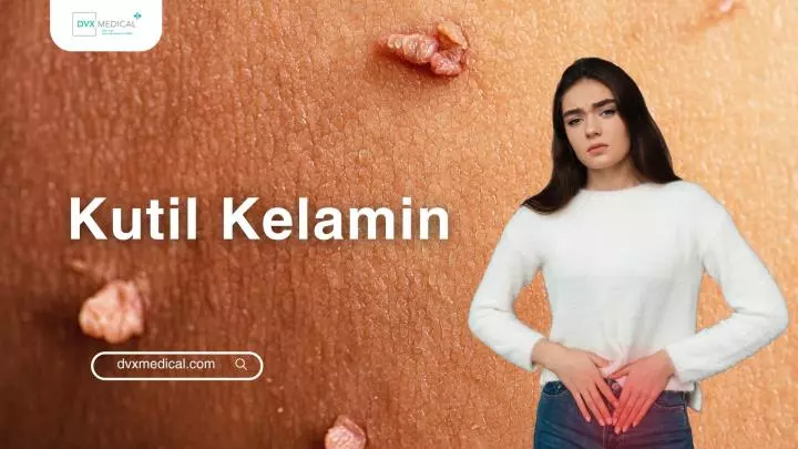 Kutil Kelamin