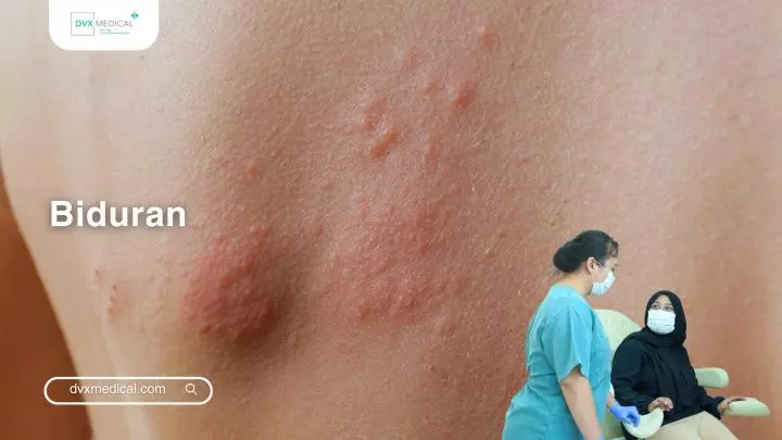 Biduran