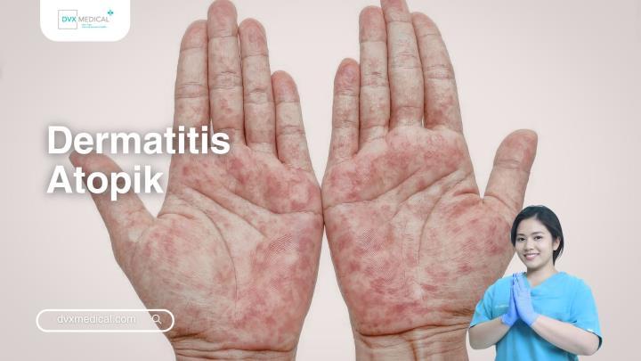 Dermatitis Atopik