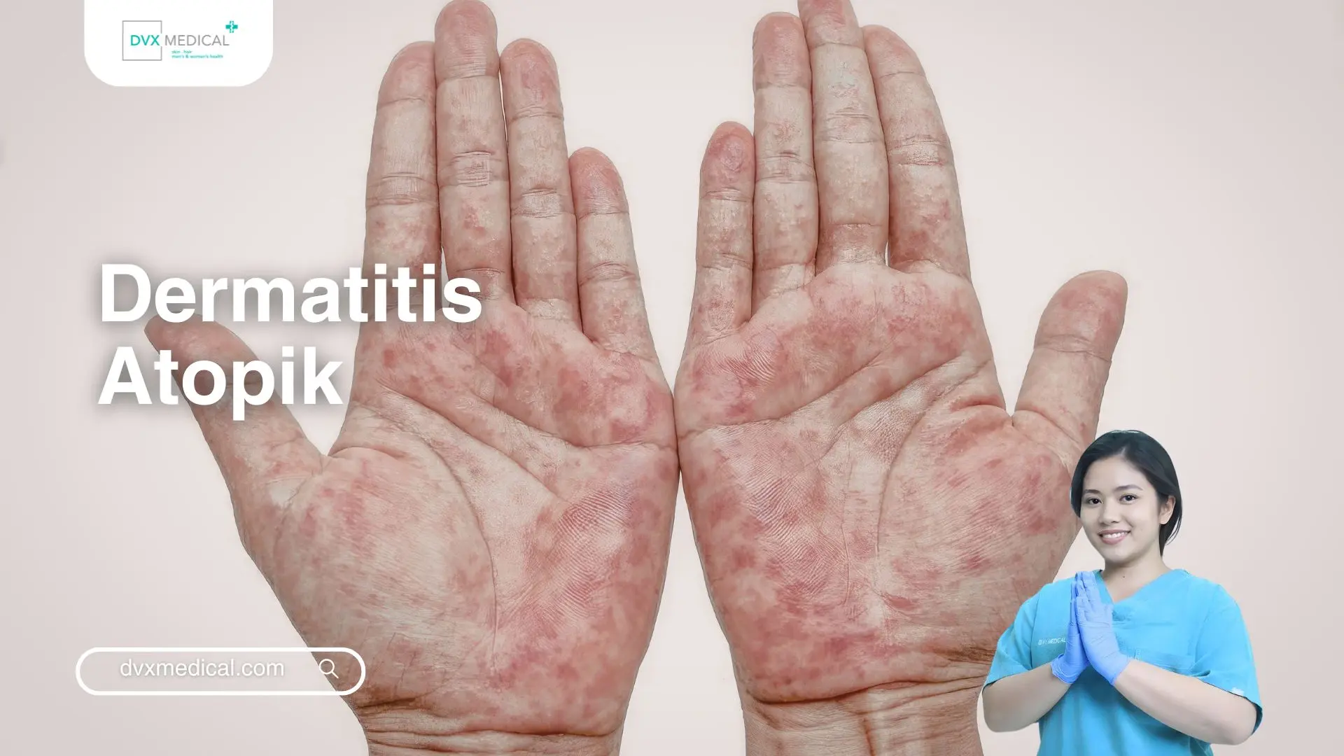 Dermatitis Atopik