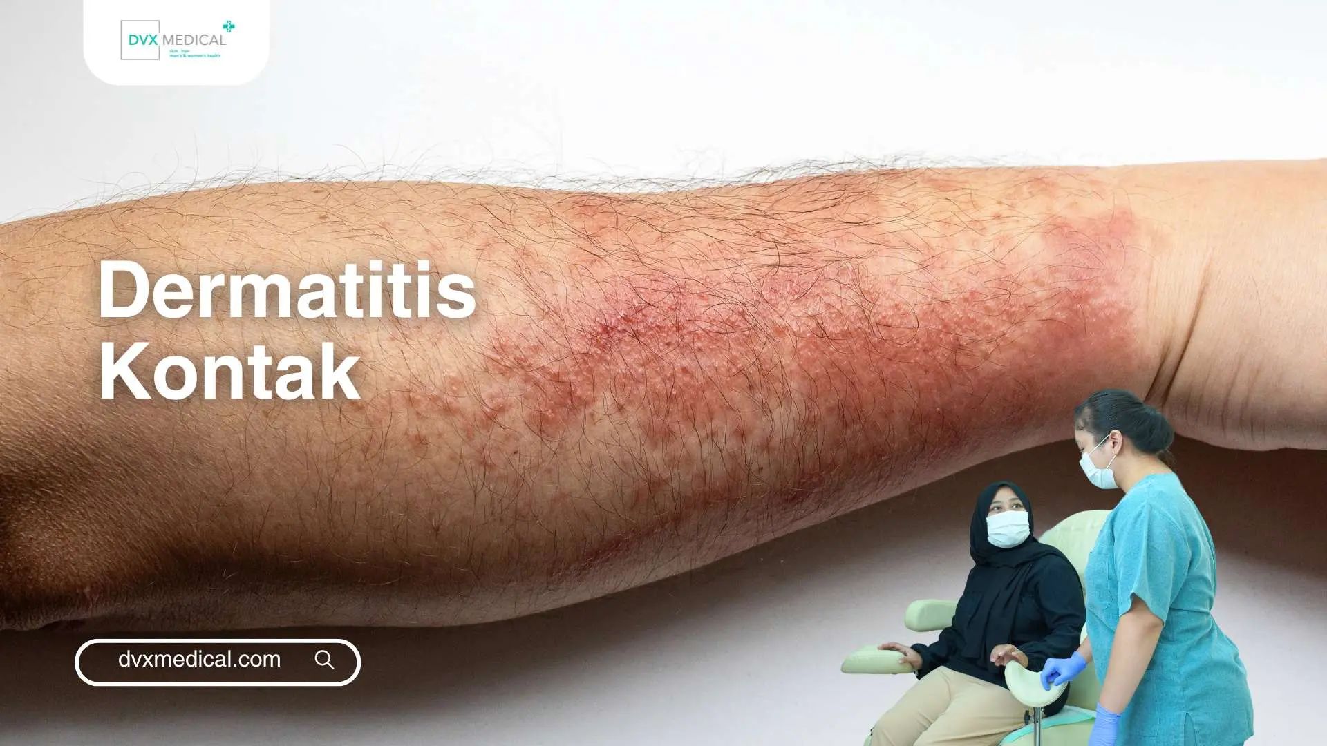 Dermatitis Kontak