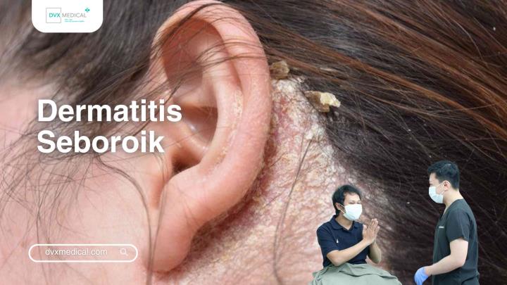 Dermatitis Seboroik