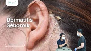 Dermatitis Seboroik