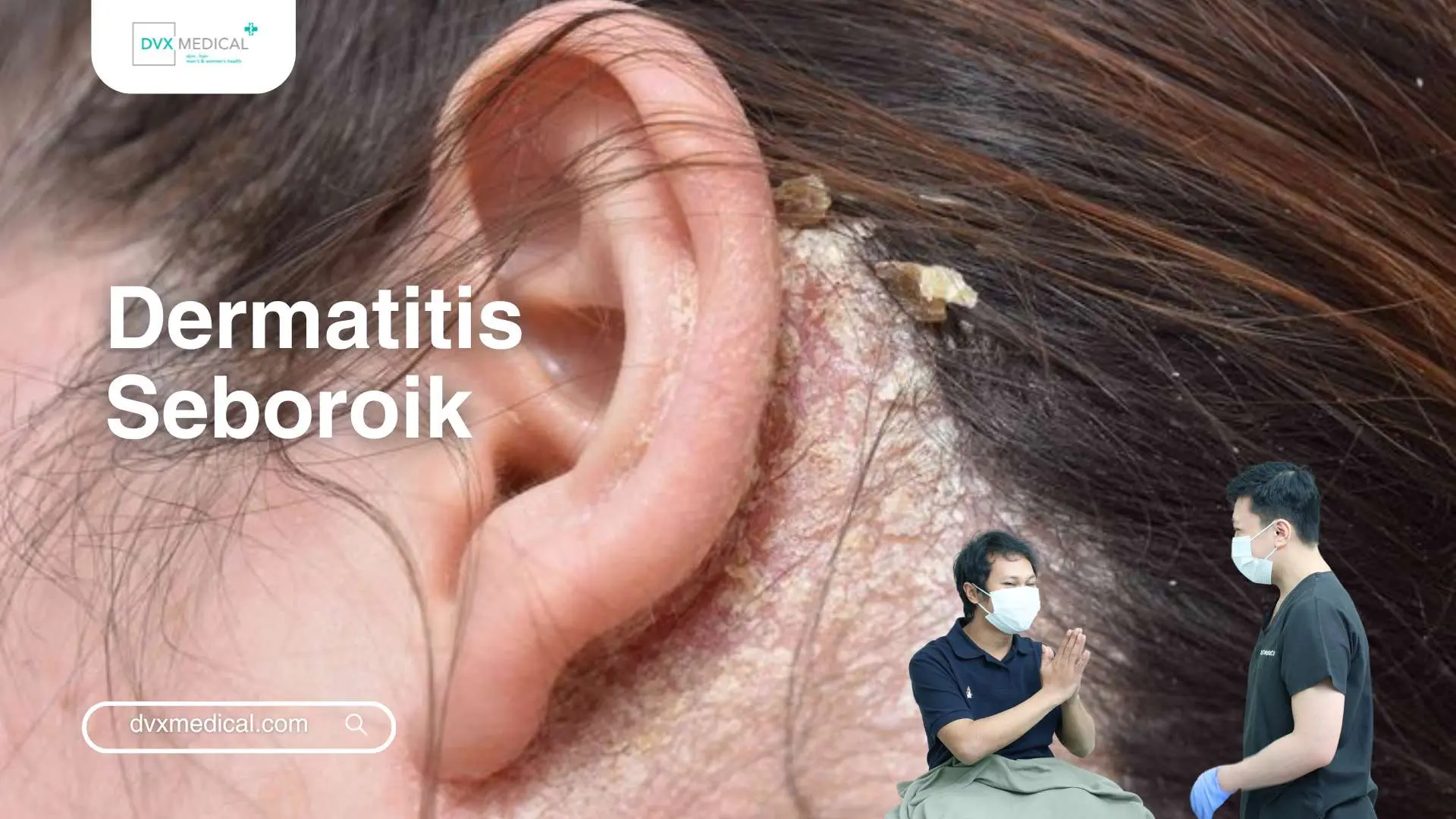 Dermatitis Seboroik
