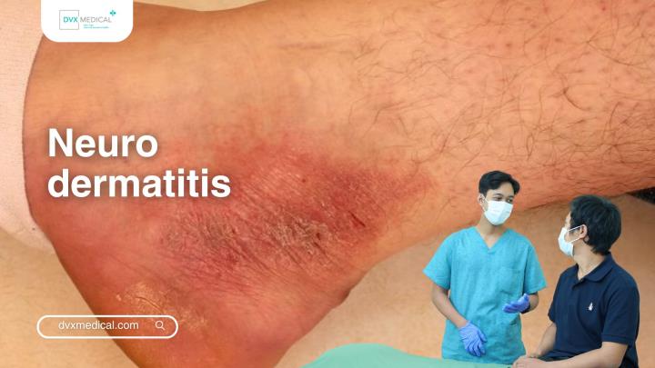 Neurodermatitis