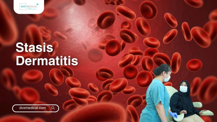 Stasis Dermatitis