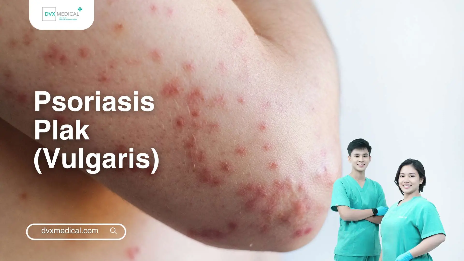 Psoriasis Plak (Vulgaris)