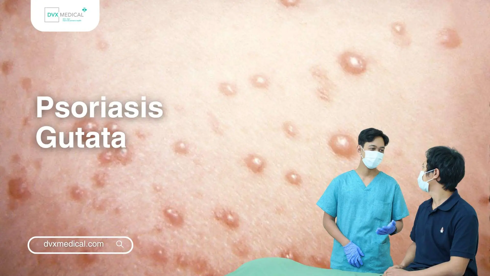 Psoriasis Gutata