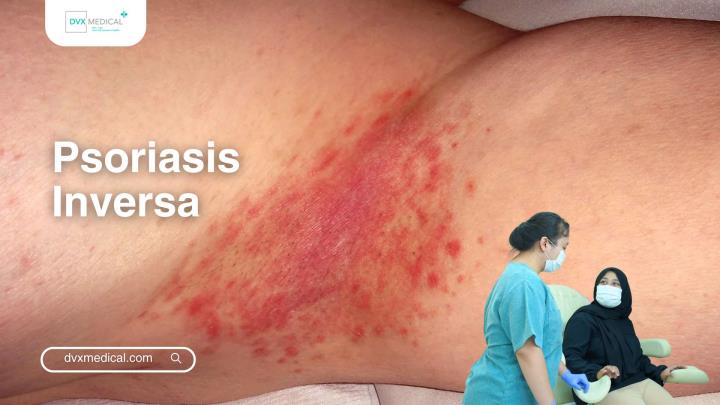 Psoriasis Inversa