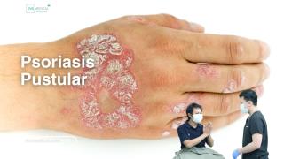 Psoriasis Pustular