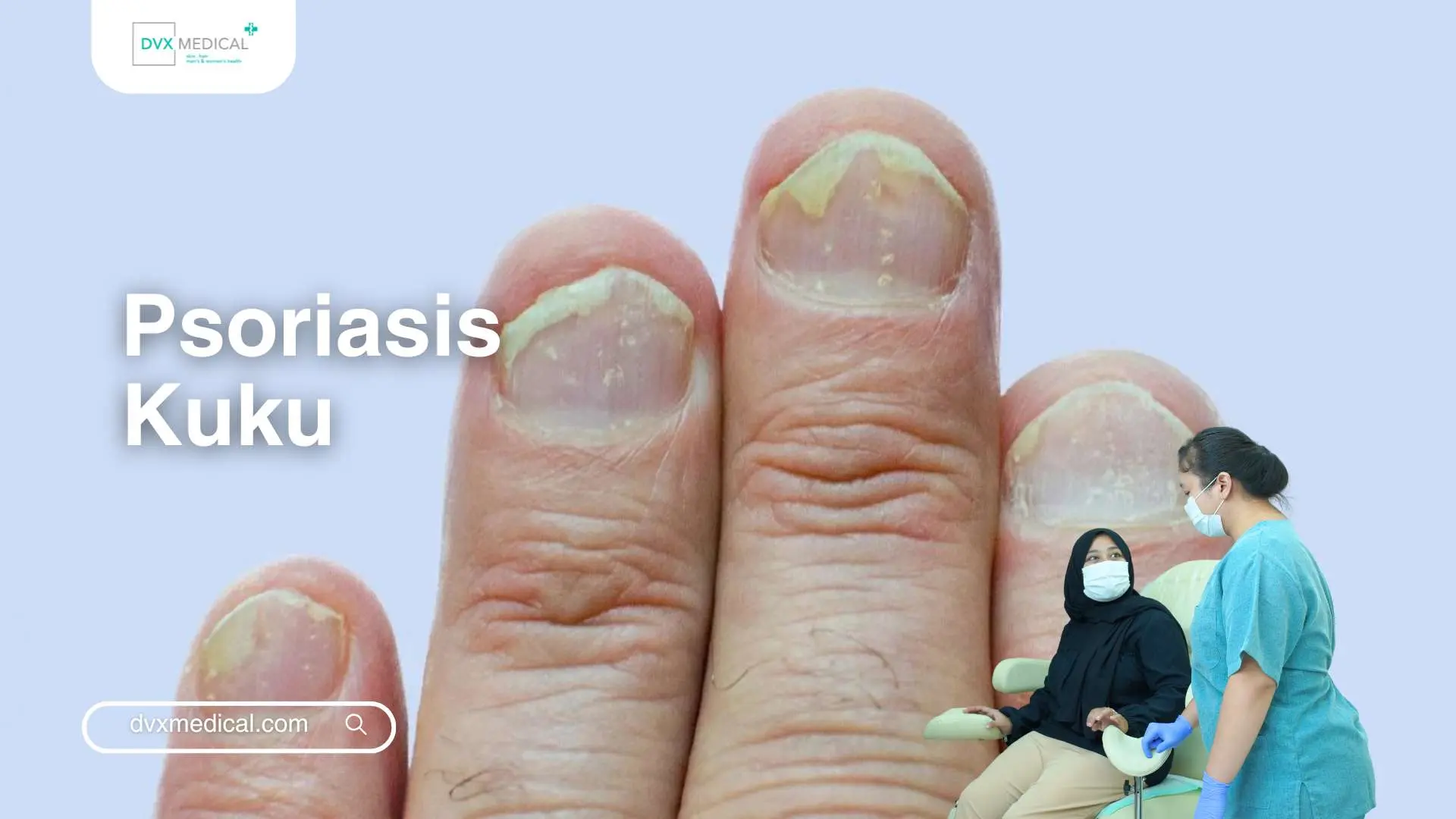 Psoriasis Kuku